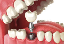 Dental Implants in Singapore 7 Things to Consider Before Replacing a Missing Tooth