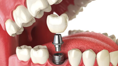 Dental Implants in Singapore 7 Things to Consider Before Replacing a Missing Tooth