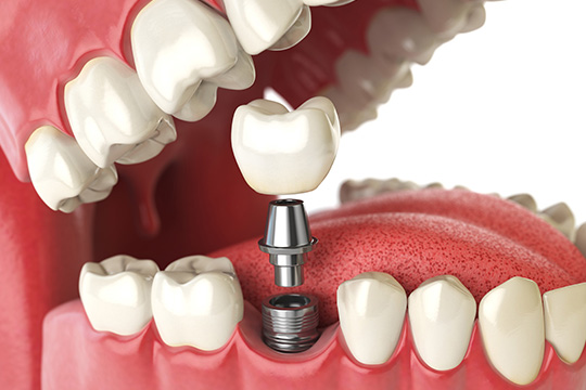 Dental Implants in Singapore 7 Things to Consider Before Replacing a Missing Tooth